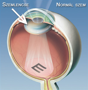 látásképzés javítja a látást rácsok a látás fejlesztésére