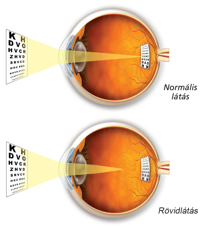 Rövidlátás, Myopia, fénytörési betegség - Budai Egészségközpont