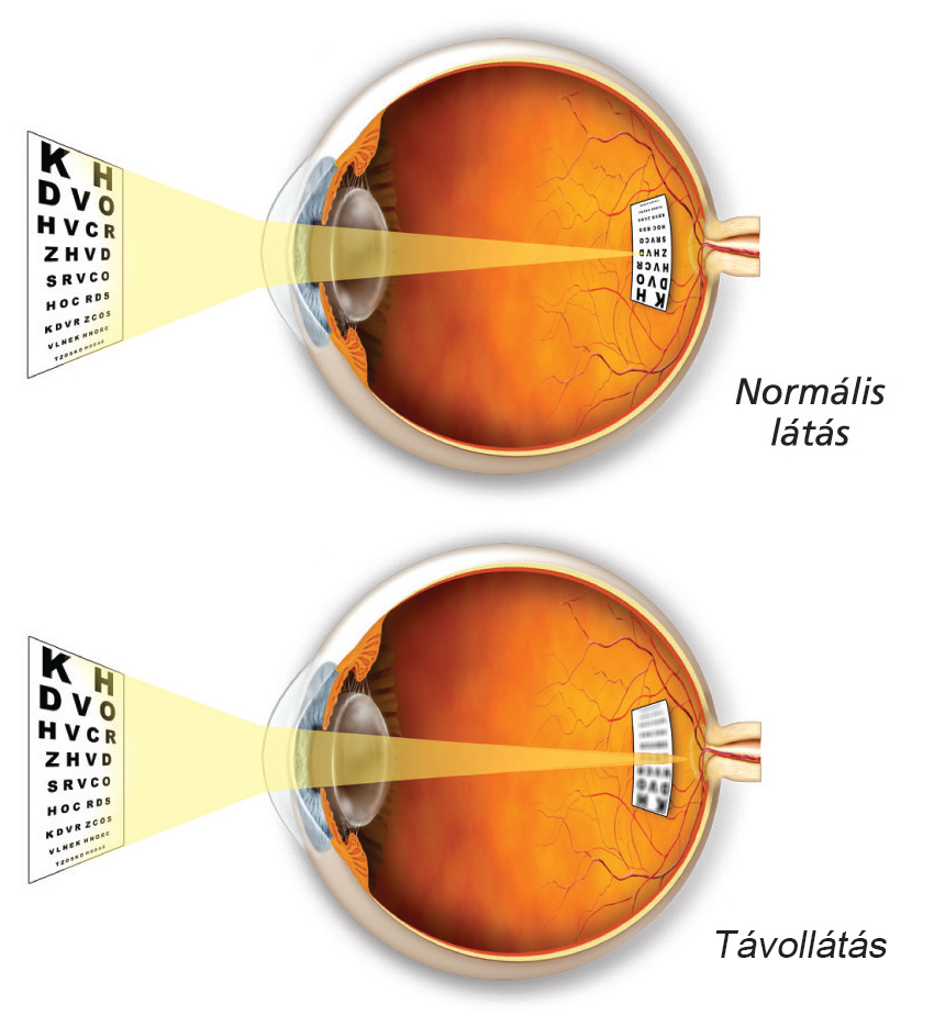 A látáskárosodás típusai